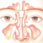 その口臭の原因、もしかしたら鼻の病気かも！？